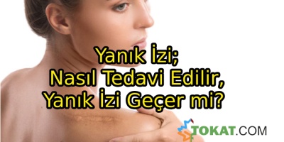 Yanık İzi; Nasıl Tedavi Edilir, Yanık İzi Geçer mi?