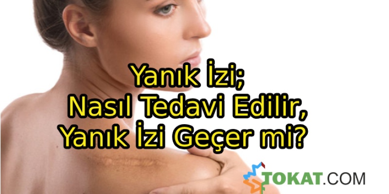 Yanık İzi; Nasıl Tedavi Edilir, Yanık İzi Geçer mi?